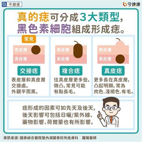 痣為什麼會凸起來|是痣？還是皮膚癌？皮膚科醫師教你揪出「假的痣」，。